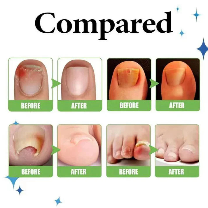 𝗔𝗻𝘁𝗶 𝗣𝗮𝗿𝗼𝗻𝘆𝗰𝗵𝗶𝗮 𝗥𝗲𝗹𝗶𝗲𝗳 𝗢𝗶𝗹 - (𝗕𝘂𝘆 𝟭 𝗚𝗲𝘁 𝟭 𝗙𝗥𝗘𝗘🔥🔥)