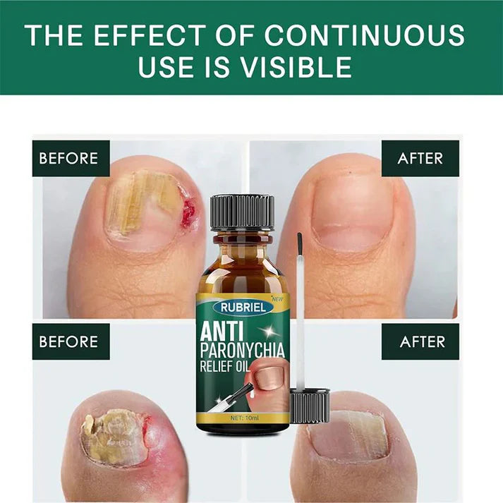 𝗔𝗻𝘁𝗶 𝗣𝗮𝗿𝗼𝗻𝘆𝗰𝗵𝗶𝗮 𝗥𝗲𝗹𝗶𝗲𝗳 𝗢𝗶𝗹 - (𝗕𝘂𝘆 𝟭 𝗚𝗲𝘁 𝟭 𝗙𝗥𝗘𝗘🔥🔥)