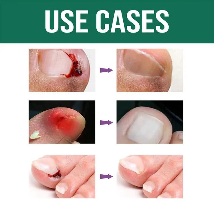 𝗔𝗻𝘁𝗶 𝗣𝗮𝗿𝗼𝗻𝘆𝗰𝗵𝗶𝗮 𝗥𝗲𝗹𝗶𝗲𝗳 𝗢𝗶𝗹 - (𝗕𝘂𝘆 𝟭 𝗚𝗲𝘁 𝟭 𝗙𝗥𝗘𝗘🔥🔥)